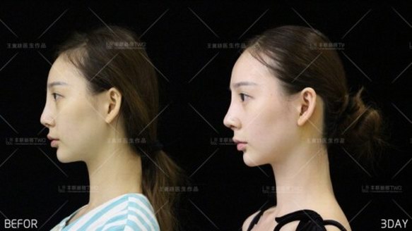 豐聯麗格王冀耕院長受邀示范“超體”鼻整形