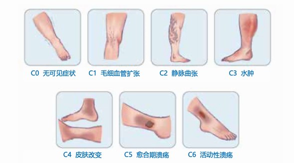 互聯網洞察助力規范診療，讓1.2億患者夏天不懼“蚯蚓腿”
